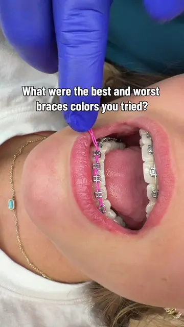 Teal is my patients’ favorite, but my personal favorite is metallic silver. The 