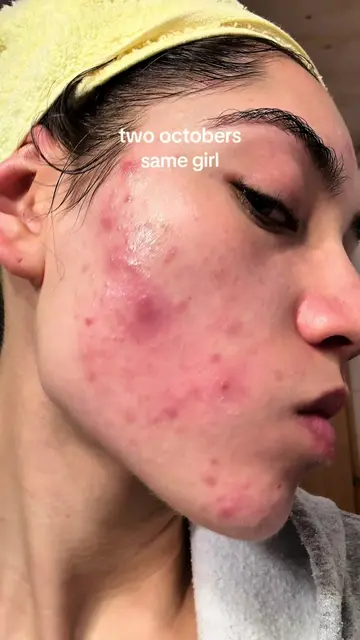 i wish i’d been as kind to her then as i am now. #inflammation #healing #skincar