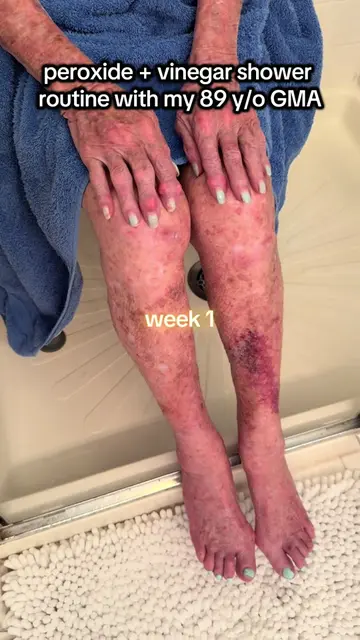 peroxide + vinegar shower routine with my 89 year old grandmother 16 week differ