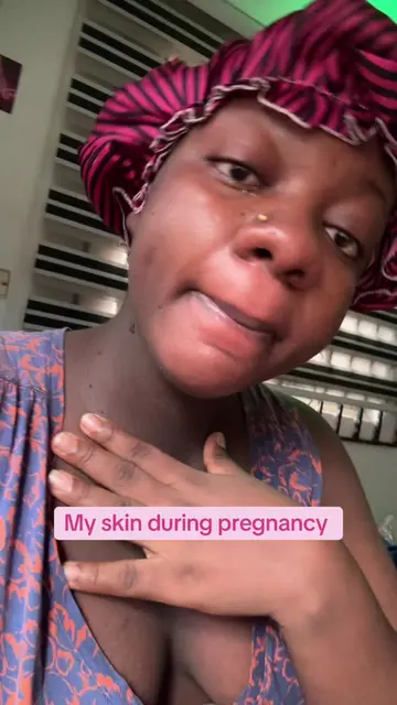 I never thought I would get my skin back #fyp my skin was nothing to write home 