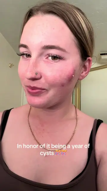 #1yearanniversary #pimples #disgusting 