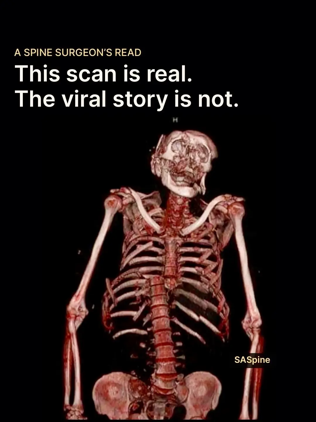 You have probably seen this 3D CT posted as a high-speed motorcycle crash, with 