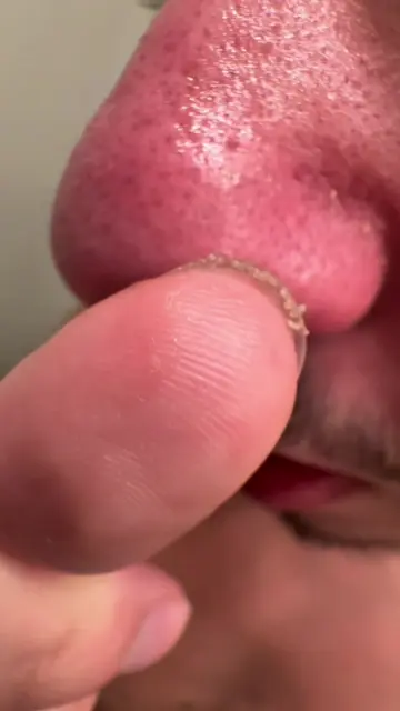 Acne scars and dark spots on my face 🤯 Keep using it and my face will gradually