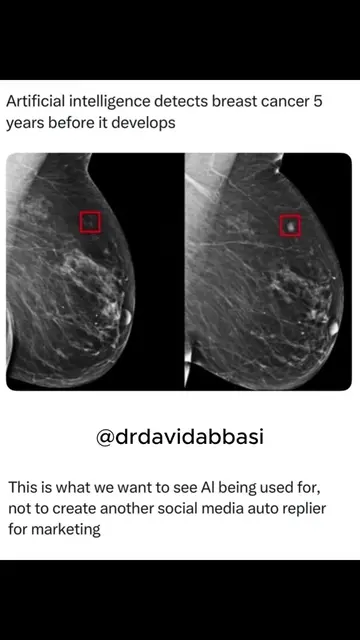 AI can now look at a mammogram and estimate your risk of breast cancer over the 