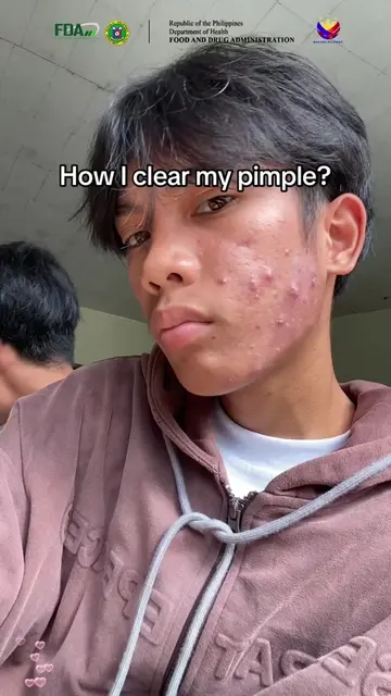 ✅ Targets acne marks and hyperpigmentation! Niacinamide serum—say goodbye to pat