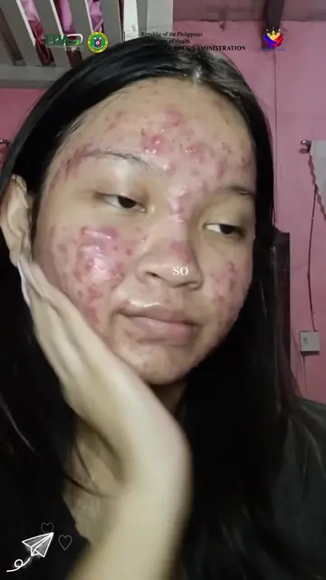 Struggling with stubborn acne marks and dark spots? 😫 Brighten and even out you