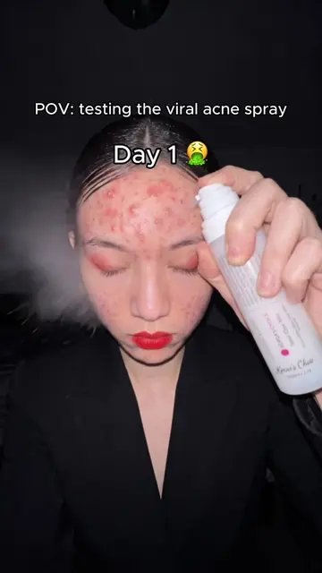 Do you need this?💕 #acne #acnecleanser #acnetreatment #acneproneskin #acneskinc