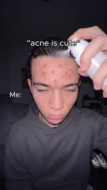 Sure bro 🤦🏻‍♂️ #acne #acnetreatment #acneproneskin #acneskincare #acnetips 