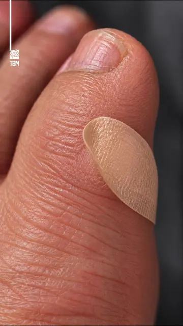 How a Corn Plaster Works - Corn plasters help treat painful foot corns using sal