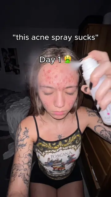 Does it suck? 🤷‍♀️👀 #acne #acnetreatment #acneproneskin #acnetreatment #acnesk